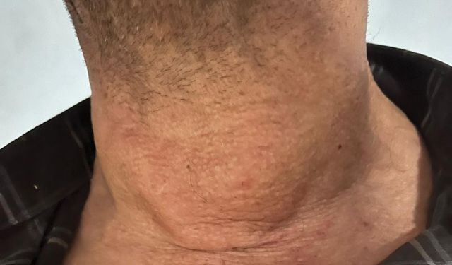 Kütahya’da guatr hastası ameliyatsız tedaviyle şifa buldu