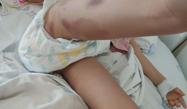 Küçük Çocuğun Ameliyatı Yanık Skandalına Döndü