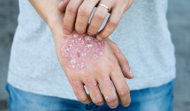 Ege'nin incisinde uyuz salgınına karşı uyarı