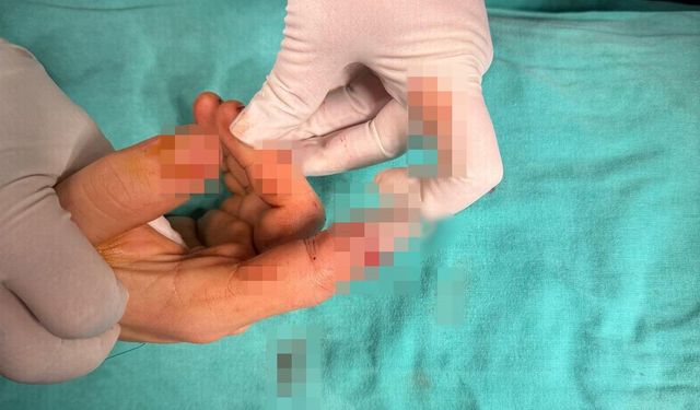 Asansör Kazası Sonrası Sevindiren Haber: Parmak Kurtarıldı