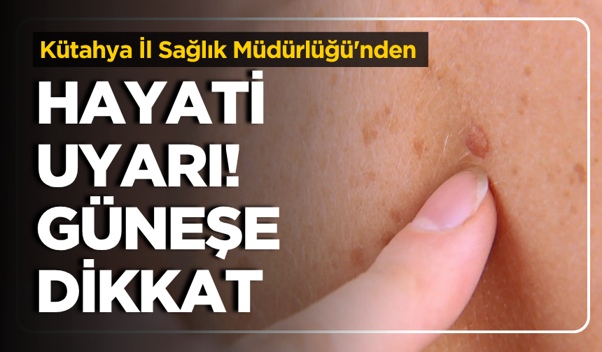 Kütahya İl Sağlık Müdürlüğü'nden Hayati Uyarı! Güneşe Dikkat